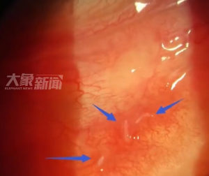 男子常吃生魚片眼中現(xiàn)活蟲 醫(yī)生提醒注意食品安全