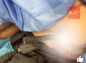 男子墜落鋼筋從襠部貫穿到腋下 醫(yī)生緊急救治轉(zhuǎn)危為安