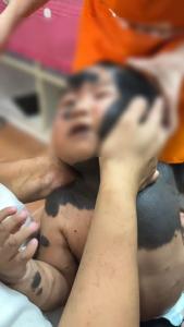 兽皮痣无法通过产检提前发现 专家详解原因