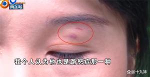 变道起纠纷司机称被别停后戳伤眼睛 路怒症引发冲突