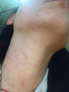 女子熟睡中遭家暴致残后续 六年刑期引发争议