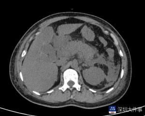 腹痛硬扛 女子确诊急性胰腺炎 误判胃肠炎险酿大祸