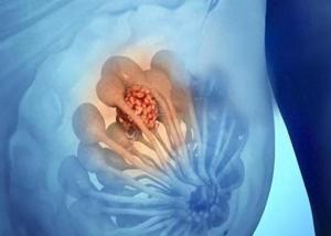 乳腺结节有3个特征更易癌变 科学应对别慌
