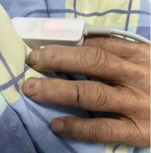 男子遭老鼠咬10天后确诊鼠咬热 警惕宠物携带细菌