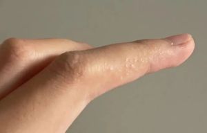 夏天手上爱长的小水疱 到底是什么 汗疱疹的特点与应对