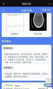 女子突发偏瘫手脚发麻确诊脑出血 熬夜备考成诱因