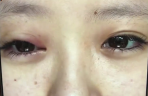 姑娘说做睫毛后眼睛肿像马蜂叮 影响旅游心情