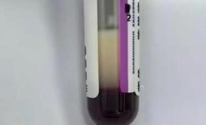 女子每天3杯奶茶 血液变乳白险丧命 奶茶爱好者需警惕