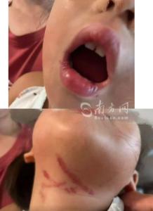 女童疑遭幼儿园男老师暴力喂食受伤 监控曝光真相