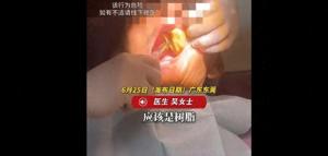 男子网购树脂自己补牙 DIY补牙反致全口重做