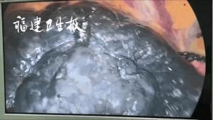45岁男子烟龄28年肺部布满炭粒 一粒花生大结节竟是肺癌