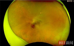 56岁女子视力骤降至0.15，竟是眼底血管“堵了” ，医生提醒：“三高”人群需警惕