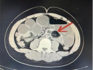 少年吃大半盘春笋后腹痛确诊肠梗阻