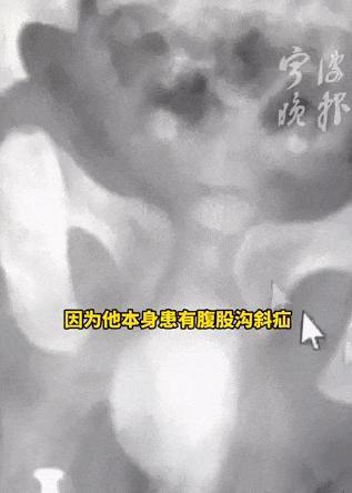 男婴阴囊内惊现螺丝钉 医生细心发现化险为夷