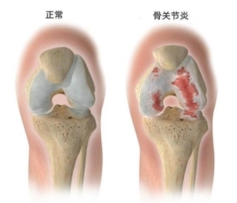 认识骨关节炎常用药：重点研读西乐葆说明书