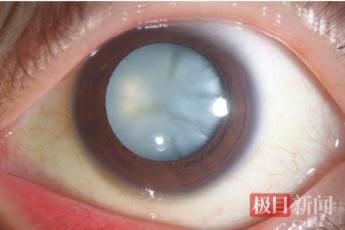 28岁小伙每天3瓶可乐近乎失明