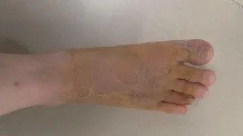 男子在沙發(fā)上睡一覺后差點(diǎn)截趾 昆蟲咬傷引發(fā)蜂窩織炎