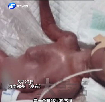 25周超早產(chǎn)兒只有巴掌大小 兩個月闖關(guān)成關(guān)成功