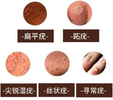 注意身上长这5种“小疙瘩”,也是HPV感染