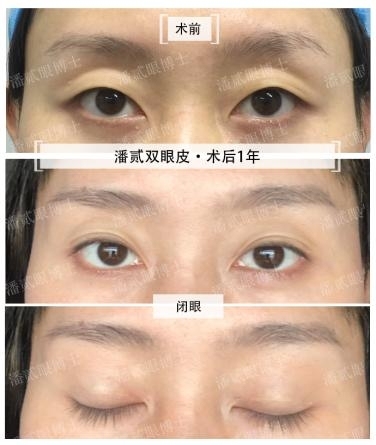 潘贰双眼皮科普书出版了！强烈推荐：《一目了然·双眼皮成形术及“失败”修复全攻略》