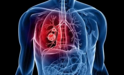 肺癌来临总"不声不响"有这4个表现尽早检查