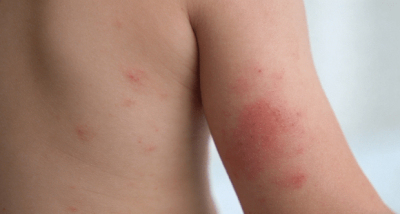 多国麻疹疫情反弹，中疾控：我国面临较大输入风险