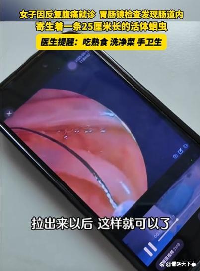 女子反复腹痛去医院检查，经发现肠道内寄生一条25厘米的蛔虫