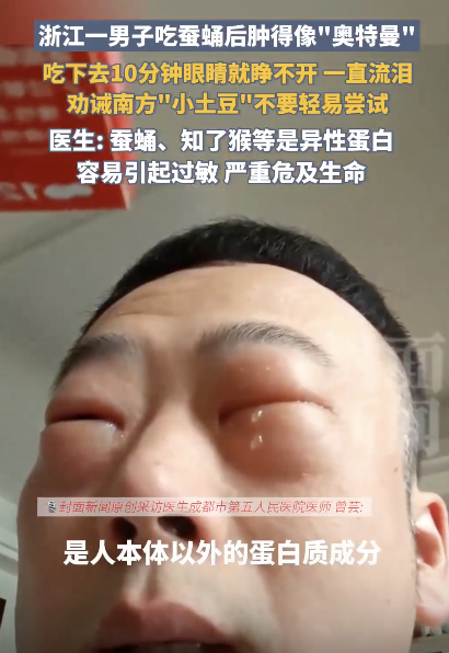 一直流泪 男子吃蚕蛹后肿得像“奥特曼” 奇异反应引热议