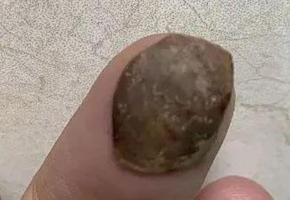 莲子壳粘嘴里湘雅医生诊断为肿瘤