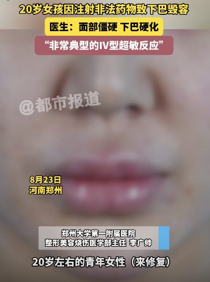 一个20岁的女孩被注射透明质酸的Bianmei被毁容！