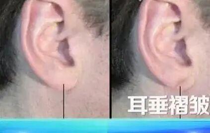 血管堵不堵 看脸和腿就知道?6个信号别忽视