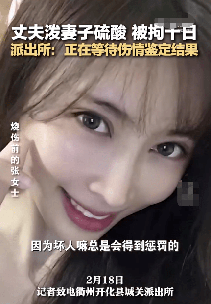 警方通报男子泼女子硫酸 女子浓硫酸烧伤11%双眼烧伤双耳烧伤