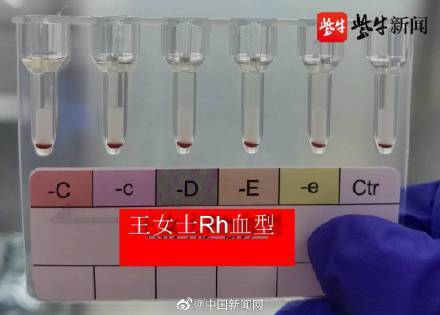 江苏发现2例全球罕见黄金血型 熊猫血全球不足50例