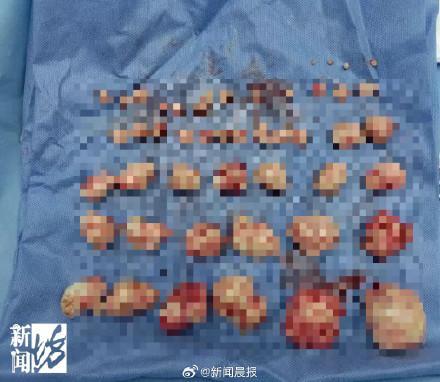 上海女子体内取出50颗子宫肌瘤 罕见病例引发关注