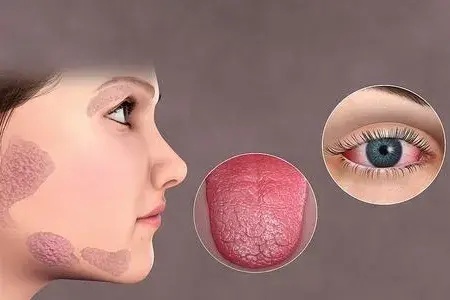 干燥综合症的主要症状都有哪些?