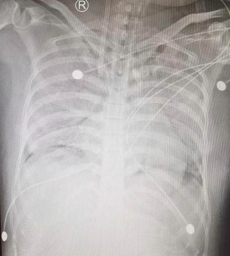阿根廷出现不明原因肺炎已致2人死亡  传播路径不明病毒还是细菌不明