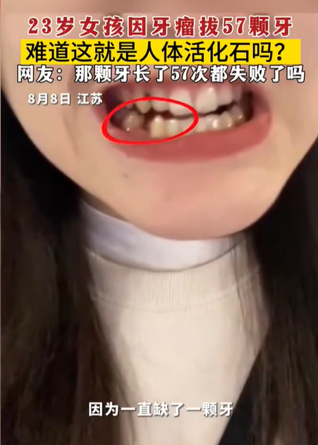 23岁女生患牙瘤拔掉57颗牙！