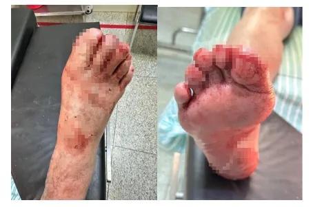 9岁女孩洗澡时玻璃爆裂被扎成血人 淋浴房隐患引关注