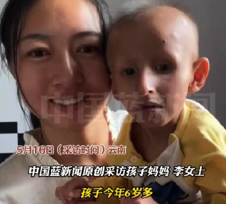 2岁儿确诊早衰症最长活至十几岁 父母四处求医-北京发布3个预警 雷电冰雹大风齐袭