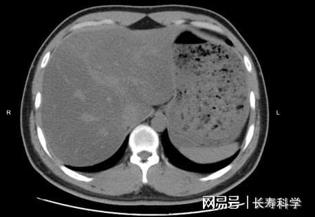 女子吃素半年吃成中重度脂肪肝！医生：切记远离这些减肥误区