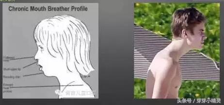 口呼吸会让人变丑是真的吗 经口呼吸面容图片大全