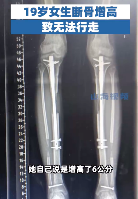 19岁女生断骨增高后无法行走！断骨增高四个字听起来不可怕吗