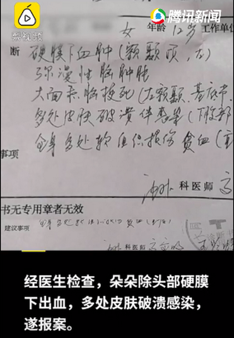 山西12岁女孩被继母打成植物人，检方将以虐待罪起诉被告人
