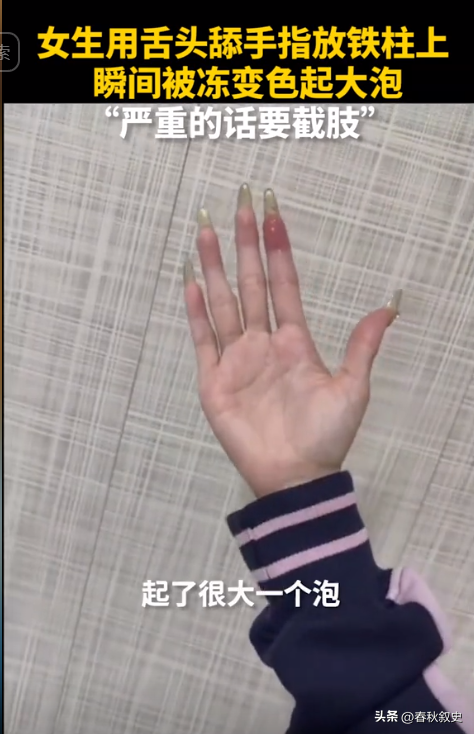 女子在漠河手指蘸口水摸铁被冻伤 好奇尝试代价惨痛