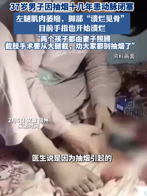 37歲男子因抽煙十幾年患上脈管炎手腳潰爛,，做手術(shù)要從大腿截肢