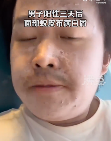 男子阳性3天后面部蜕皮布满白屑