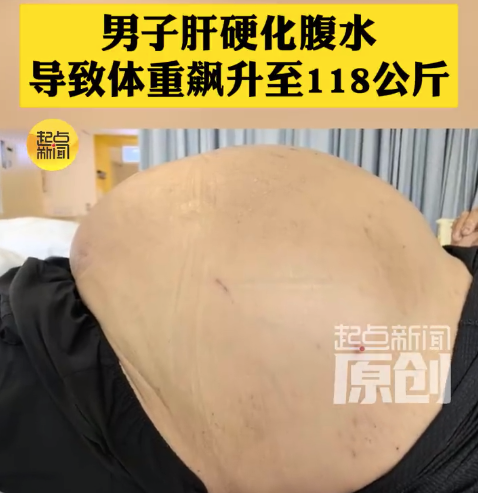 肚子大不一定是发胖！男子肝硬化腹水体重飙升至118公斤