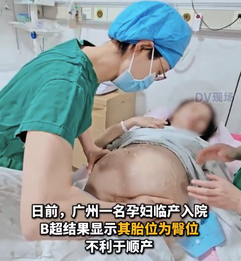 医生乾坤大挪移将臀位婴儿转头位
