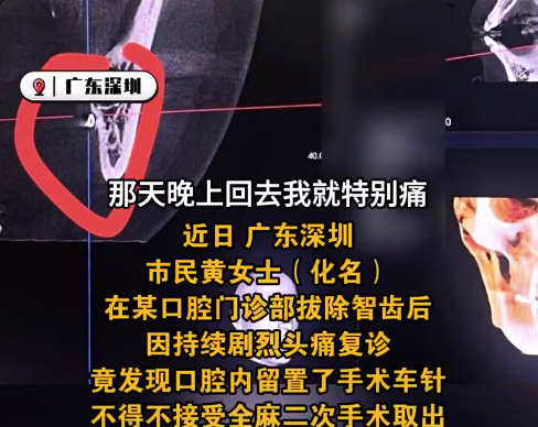 女子拔完智齒頭痛難忍嘴里竟有根針：“一天喝了三次布洛芬”,！
