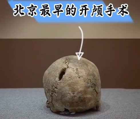 2000多年前的北京人竟然就会开颅手术